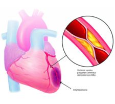 Südamelihase infarkt