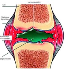 Reumatoidartriit