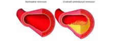 Oblitereeriv endarteriit